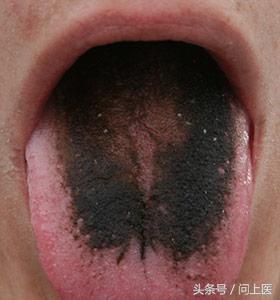 药物极罕见的副作用需要担心吗,7种奇怪药物副作用