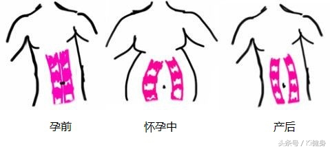 腹直肌分离要锻炼腹外斜肌吗,腹直肌运动解剖功能图