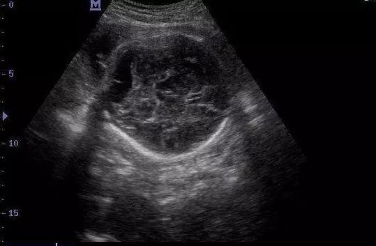 脑积水宝宝最明显表现,六个月宝宝脑积水症状