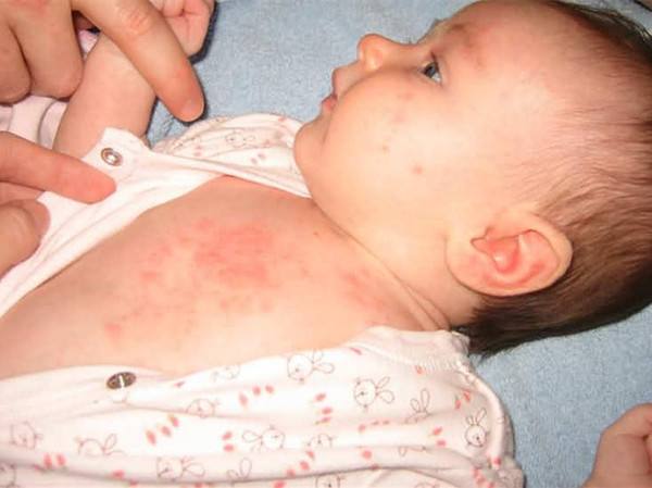 小月龄宝宝湿疹和热疹区别,宝宝粟粒疹和湿疹区别