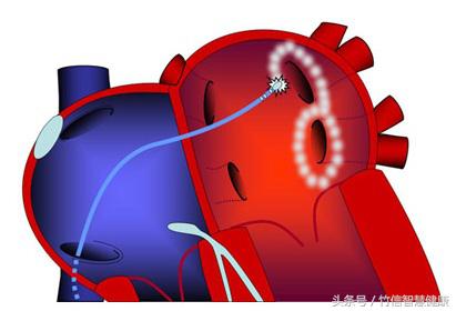 房颤患者属于慢性病吗,房颤究竟是怎么得的