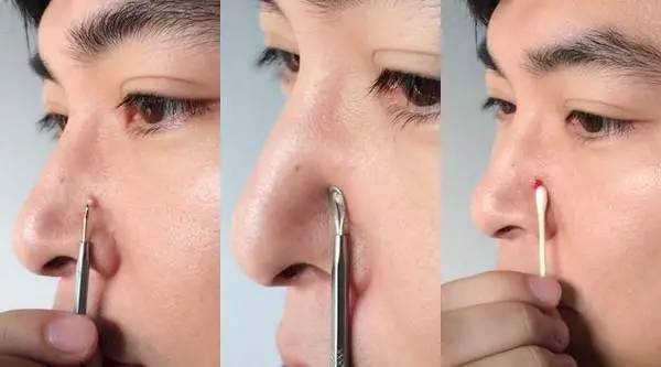 教你正确方法挤痘痘不留疤痕,正确挤痘痘的方法简单不用护肤品