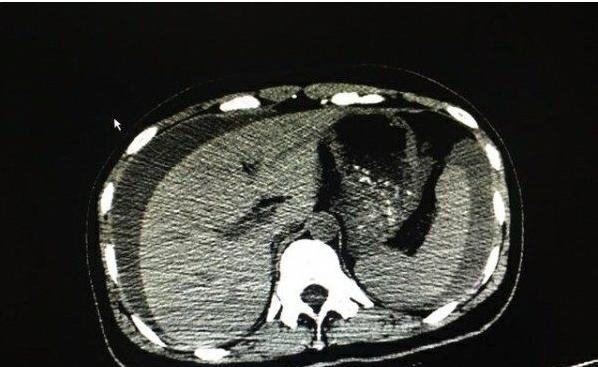 女子腹痛查出宫内宫外,女子腹痛去医院医生一看立马报警