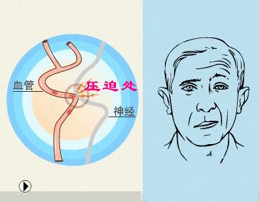 眼眉跳预兆是真的吗,眼眉跳是吉兆吗