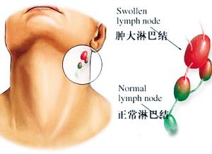 颈部淋巴结肿大不痛不痒啥原因,颈部淋巴结肿大但是不痛不痒