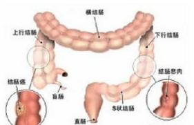 肠癌腹痛腹胀怎么处理,吗丁啉对肠癌患者腹胀有用吗