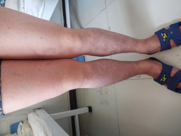 银屑病患者自述康复真实记录,银屑病患者自述真实经历