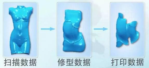 案例l3D打印支具助力青少年脊柱侧弯保守治疗