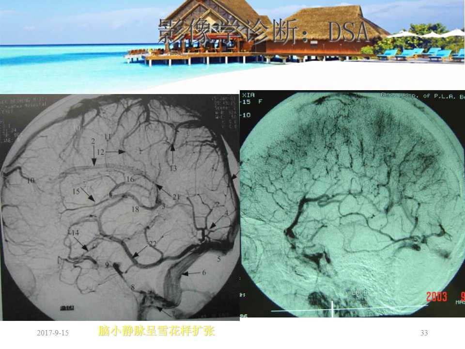 颅内静脉窦血栓形成怎么治疗,颅内静脉窦血栓怎么治疗