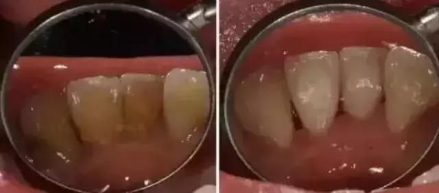 牙龈肿痛牙齿松动是怎么回事,牙齿松动咬硬东西痛怎么回事