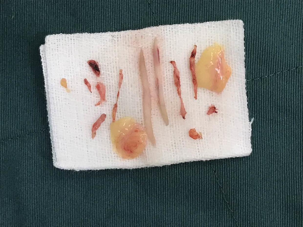 割双眼皮有哪些副作用呢,割双眼皮的利弊大揭秘