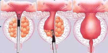 肠炎导致腹泻最快缓解的方法,肠炎引起的腹泻怎么治
