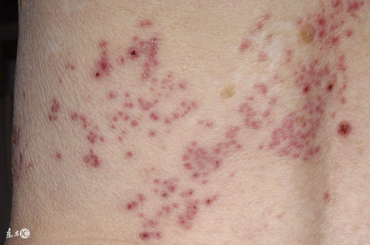 妈妈得了水痘宝宝怎么预防,大人护理儿童水痘的防范措施