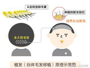 脱发发际线上扬怎么办,严重脱发秃顶发际线后移如何改善