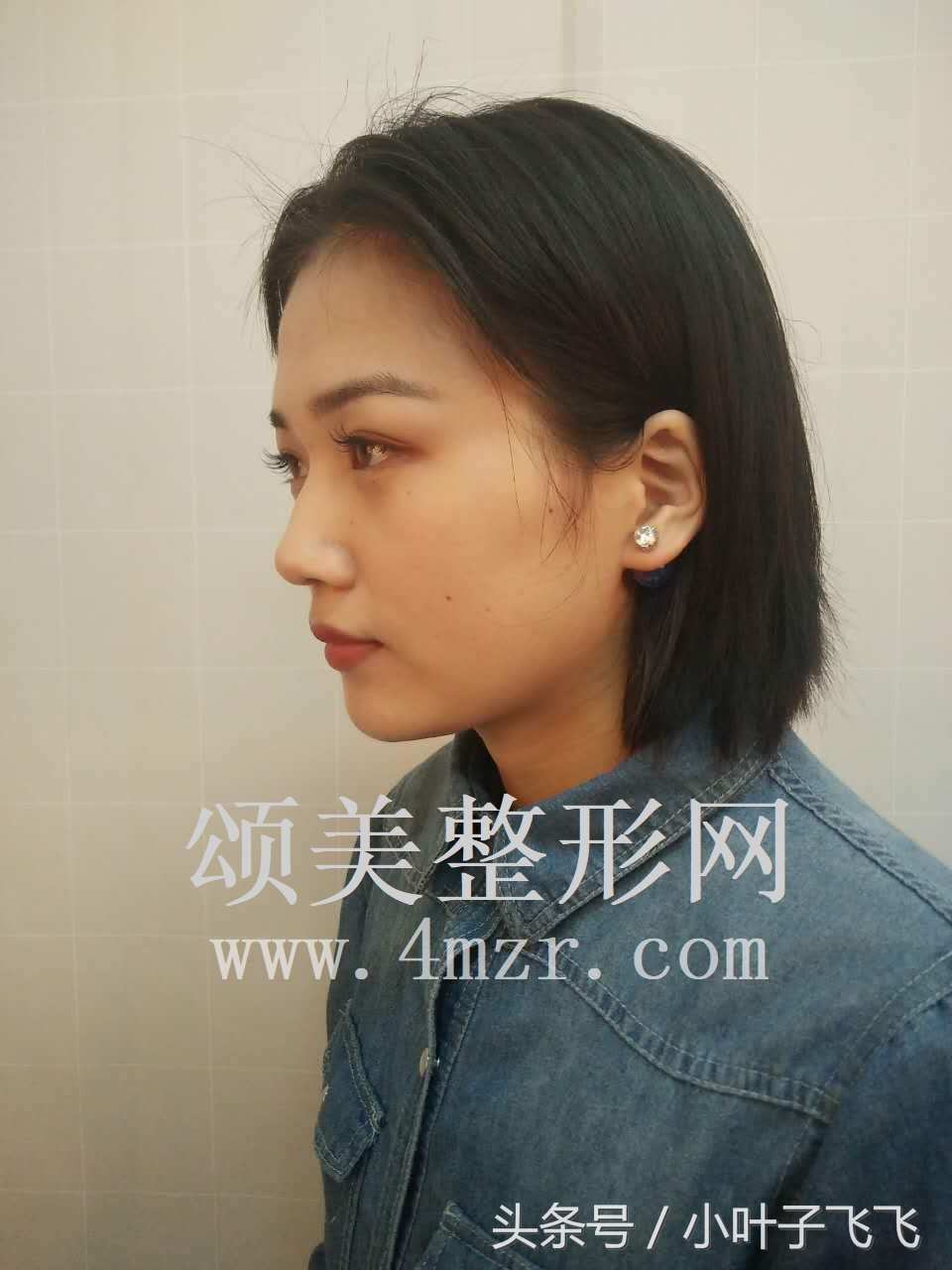 伊婉玻尿酸打面部提升效果怎么样,伊婉玻尿酸中分子打下巴会变形吗