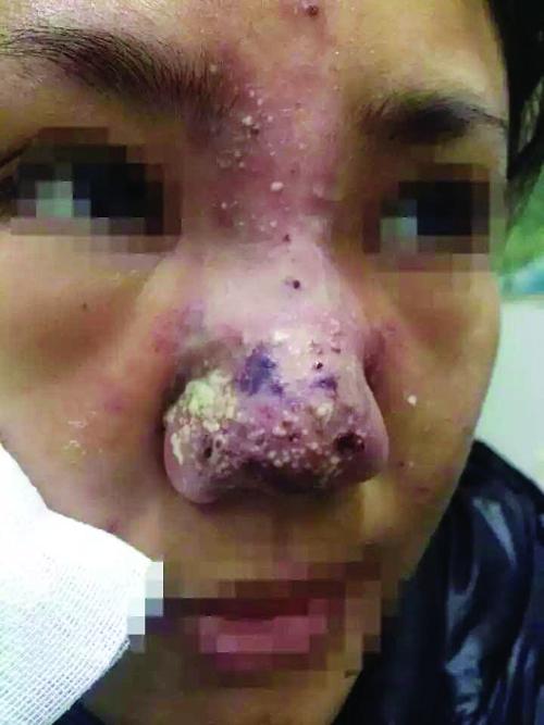 用玻尿酸打了鼻子,用玻尿酸注射隆鼻