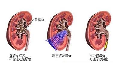 男性肾结石患者结石如何排出体外,肾结石1.6厘米结石能体外碎石吗