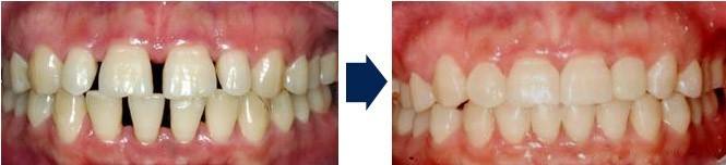 牙齿有缝能用牙套矫正吗,牙齿有缝可以补吗