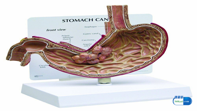 替吉奥胶囊专治胃癌吗,替吉奥胶囊能控制胃癌吗