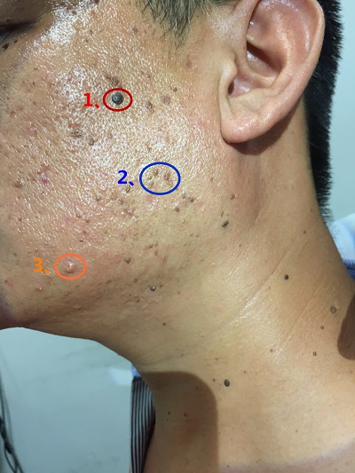 脸上的痘痘有哪几种类型,脸上的痘痘都有哪几种