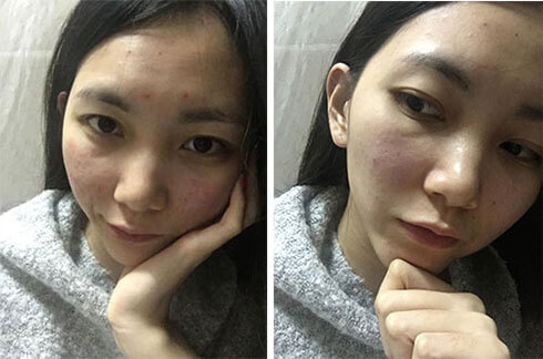 一个月解决痘痘方法,一个多月的痘痘怎么消