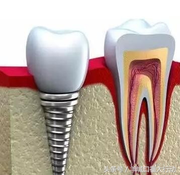 钛金种植牙的危害,正畸种植牙的危害