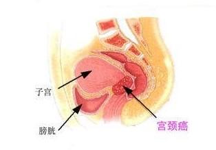 宫颈癌前筛查你做了吗?