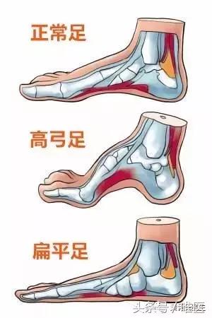 经常崴脚这些护踝功课快快收起,怎么样才能避免运动时脚崴