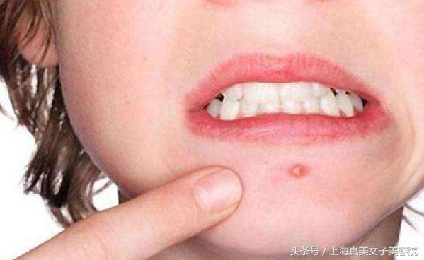 下巴和嘴周围经常冒痘？有对策！