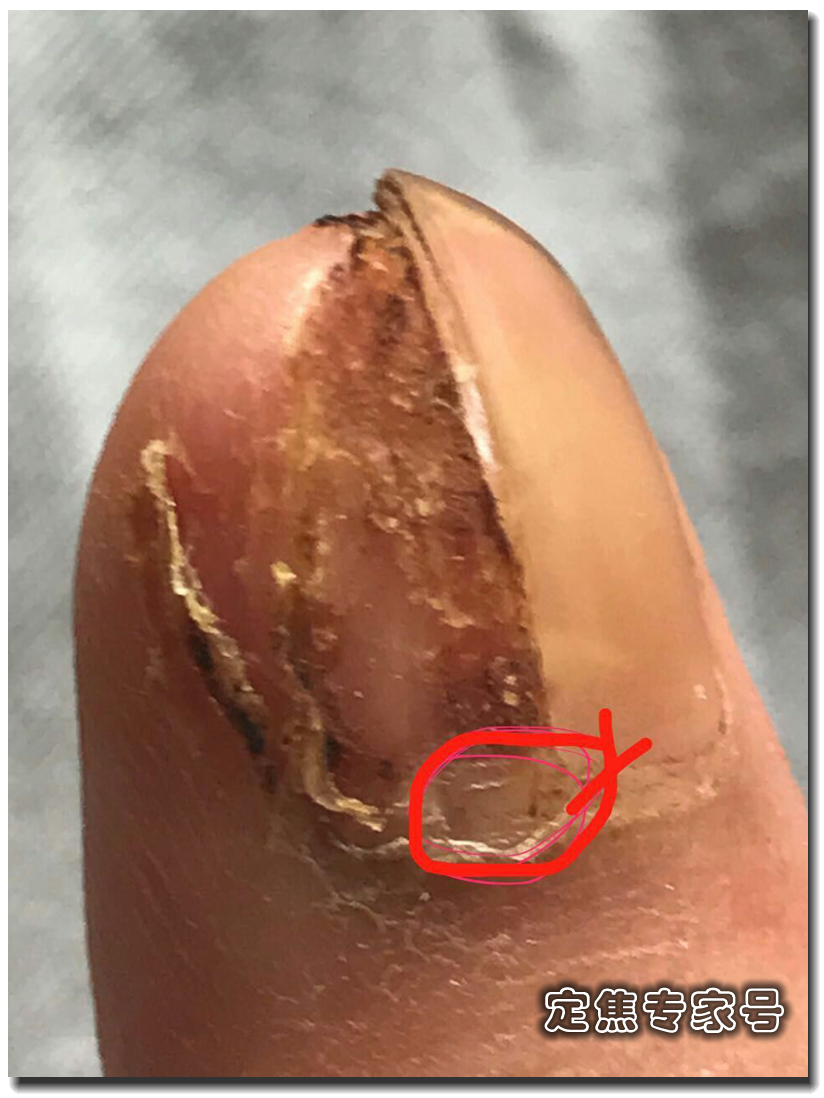 手指长黑痣需要割吗,高中生指甲上有白点怎么治