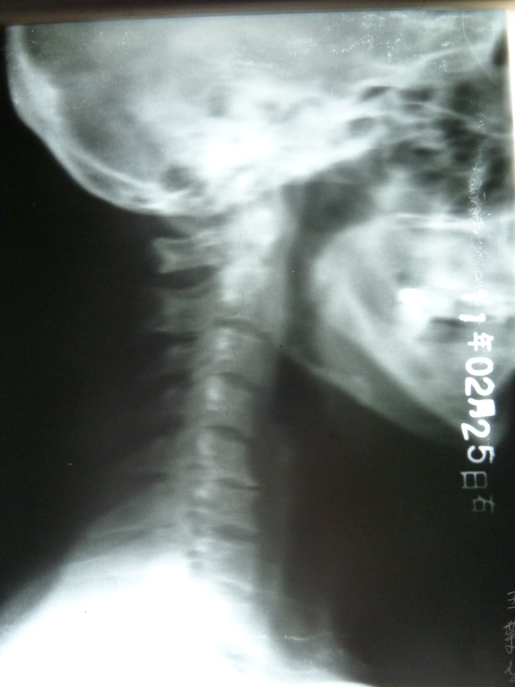 重庆治疗颈椎病最好的医院,治疗颈椎病的锻炼方法视频