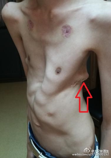 胸廓畸形能恢复吗,高难度胸廓畸形手术