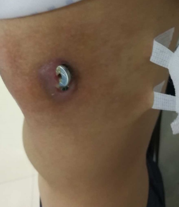 胸廓畸形能恢复吗,高难度胸廓畸形手术