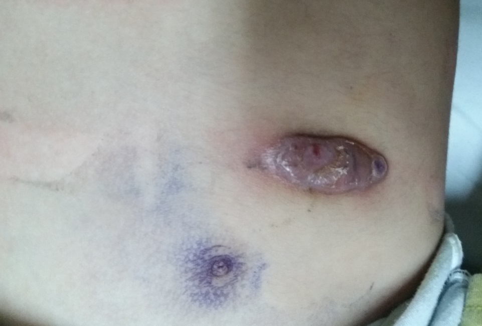 胸廓畸形能恢复吗,高难度胸廓畸形手术