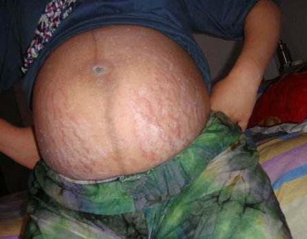 产后橄榄油可以去除妊娠纹吗,产后祛除妊娠纹最有效的方法