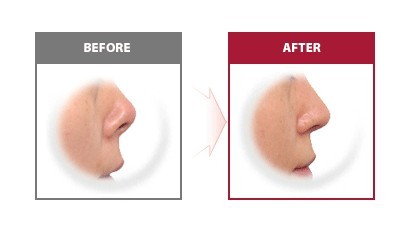 鼻子整形的方法有几种,鼻子整形方法都有哪些图片