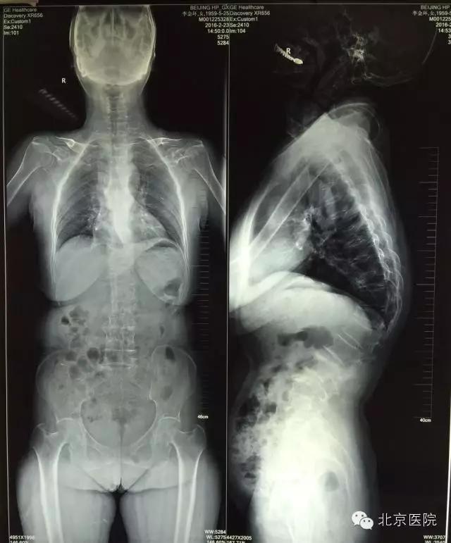 骨科医生教你改善驼背,北京哪家医院治疗脊椎弯曲驼背