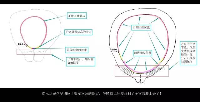 “胎盘低置状态”是个什么状态?