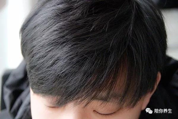 为什么男人易秃顶,为什么男人到了中年就容易秃顶呢