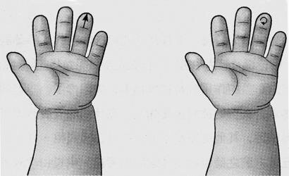 大人得了肺炎严重吗,得了肺炎怎么办