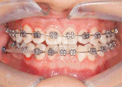 正畸过程全记录,正畸的几个阶段和步骤