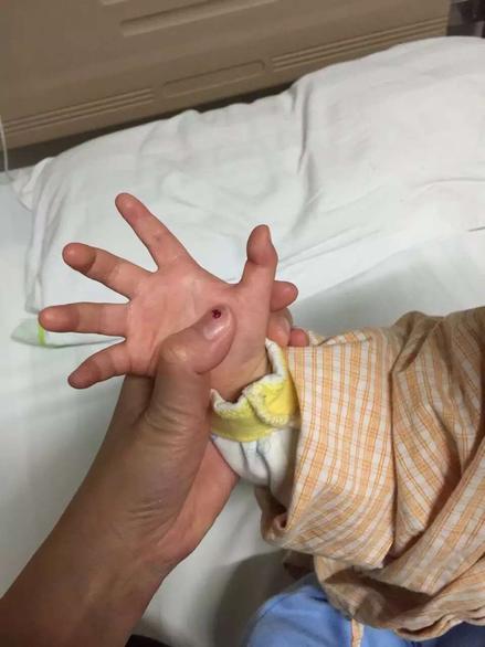 手指腱鞘炎怎么治,膏药能治腱鞘炎吗