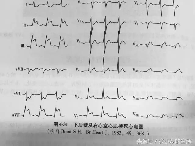 心绞痛与急性心肌梗死的鉴别,不稳定型心绞痛和急性心肌梗死
