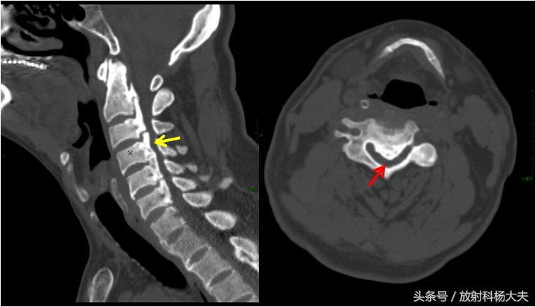 神经根型颈椎病能按摩引起腿麻吗,颈椎x片能确诊颈椎病吗
