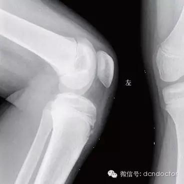 成年人胫骨结节软骨炎要怎么治疗,孩子胫骨结节软骨炎很疼怎么办