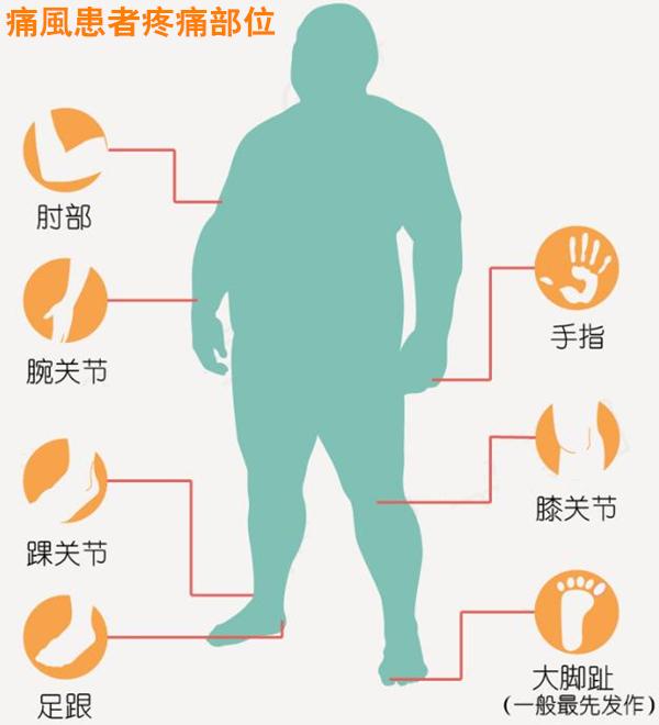 痛风治疗注意这4点,痛风治疗的五种方法