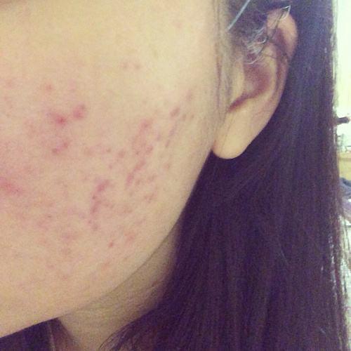 补锌与痘痘,补锌能缓解痘痘的生长吗