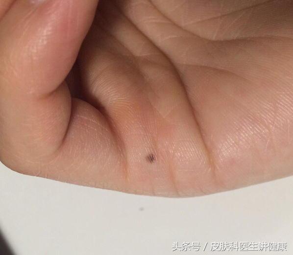 一公分的痣可以做手术切除吗,去医院医生说痣太大了只能做手术