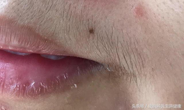 一公分的痣可以做手术切除吗,去医院医生说痣太大了只能做手术