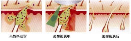 粉刺没有处理好变成硬疙瘩,痘痘粉刺消不掉